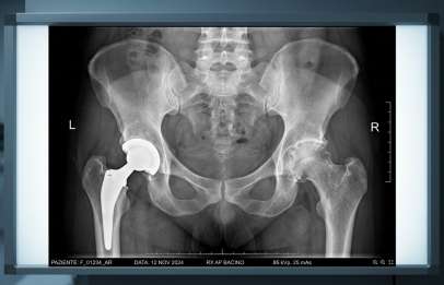 radiografia anca