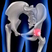 Artrosi dell’anca (coxartrosi): cos’è davvero, come si manifesta e quando operare