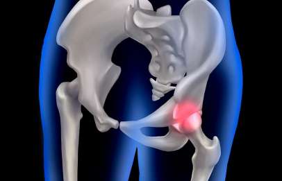 Coxartrosi anca